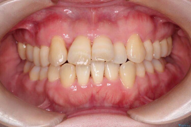 前歯のかみ合わせを改善したい 治療前画像