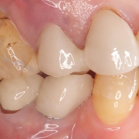 歯根破折による抜歯即時インプラント（1DAYインプラント） 治療前
