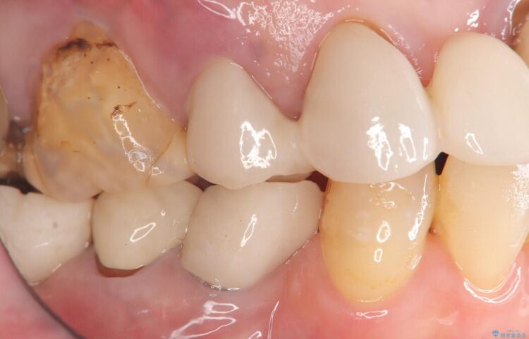 歯根破折による抜歯即時インプラント（1DAYインプラント） 治療前画像