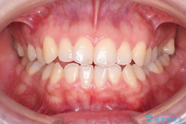 大人になってからのオープンバイト（開咬）の矯正治療 治療前