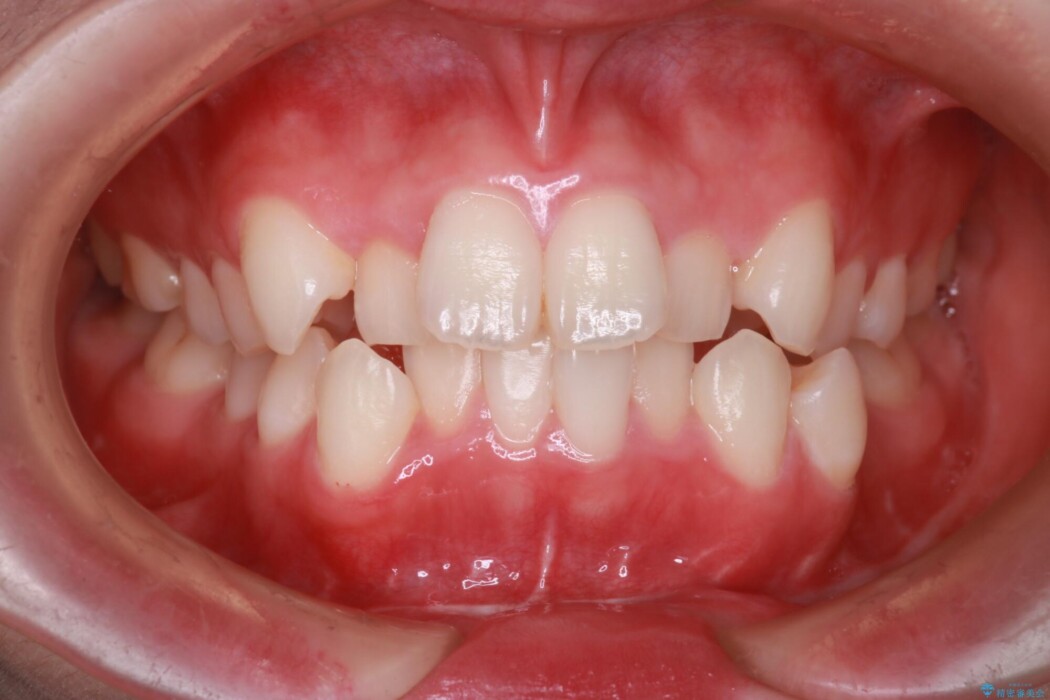 インビザラインでの抜歯矯正治療 治療前