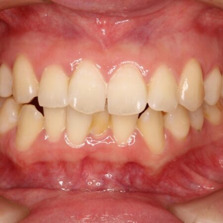 前歯のガタガタをなおしたい　インビザラインでのマウスピース矯正治療 治療前