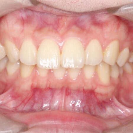 前歯の正中線のズレをなおす 治療前