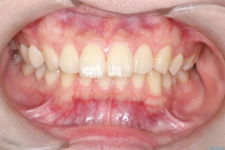 前歯の正中線のズレをなおす 治療前画像