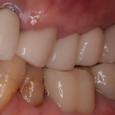 【1Dayインプラント】抜歯の即日にインプラントを埋入する 治療前