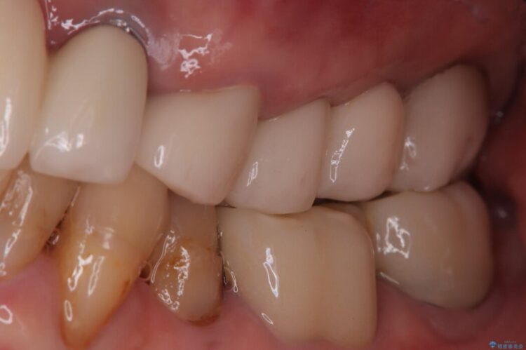 【1Dayインプラント】抜歯の即日にインプラントを埋入する 治療前画像