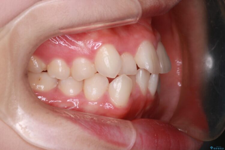 インビザラインでの抜歯矯正治療 治療前画像