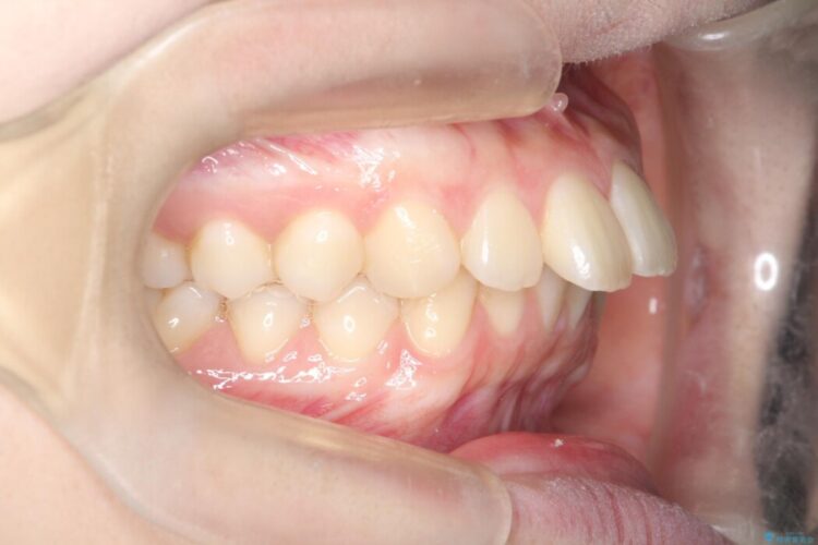 前歯の正中線のズレをなおす 治療前画像