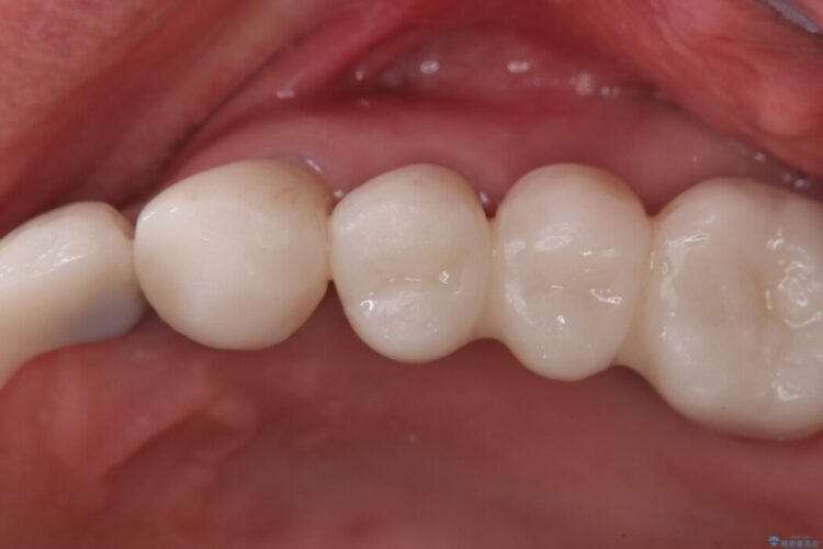 【1Dayインプラント】抜歯の即日にインプラントを埋入する 治療前画像