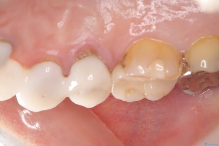 歯根破折による抜歯即時インプラント（1DAYインプラント） 治療前画像