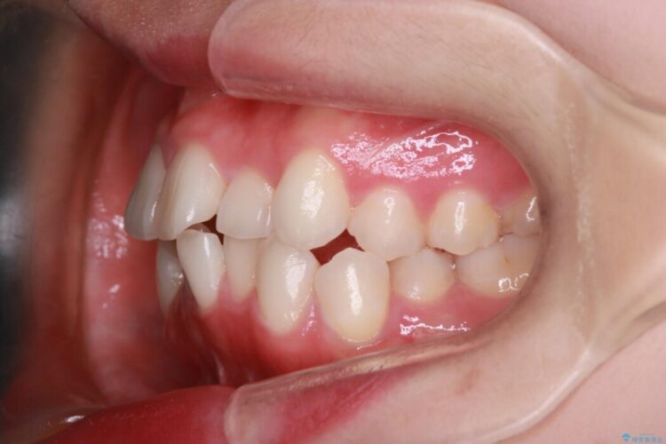 インビザラインでの抜歯矯正治療 治療前画像