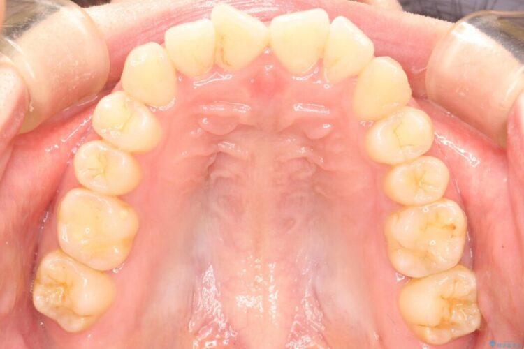 前歯のガタガタをなおしたい　インビザラインでのマウスピース矯正治療 治療前画像