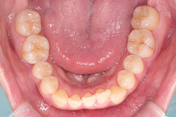 前歯のかみ合わせを改善したい 治療前画像