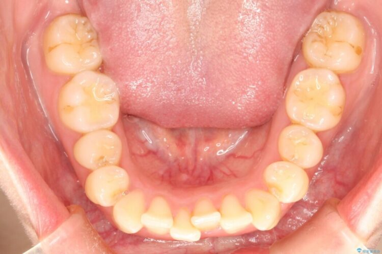 前歯のガタガタをなおしたい　インビザラインでのマウスピース矯正治療 治療前画像