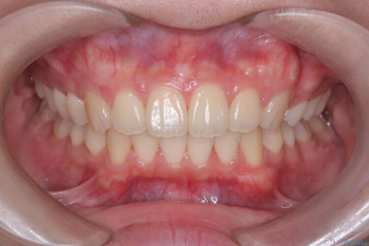 前歯の正中線のズレをなおす 治療後画像