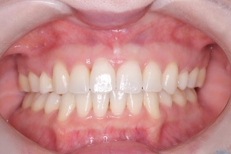 前歯のガタガタをなおしたい　インビザラインでのマウスピース矯正治療 アフター