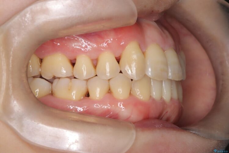 前歯のかみ合わせを改善したい 治療後画像