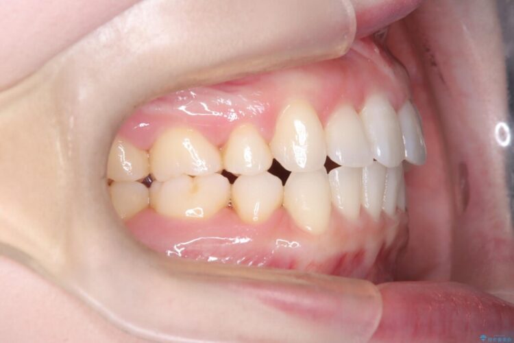 前歯のガタガタをなおしたい　インビザラインでのマウスピース矯正治療 治療後画像