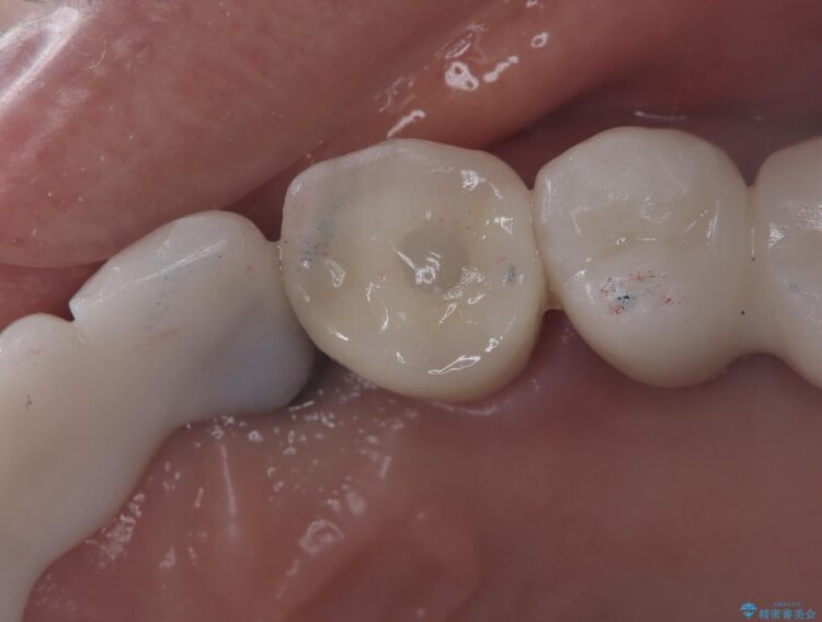 【1Dayインプラント】抜歯の即日にインプラントを埋入する 治療後画像