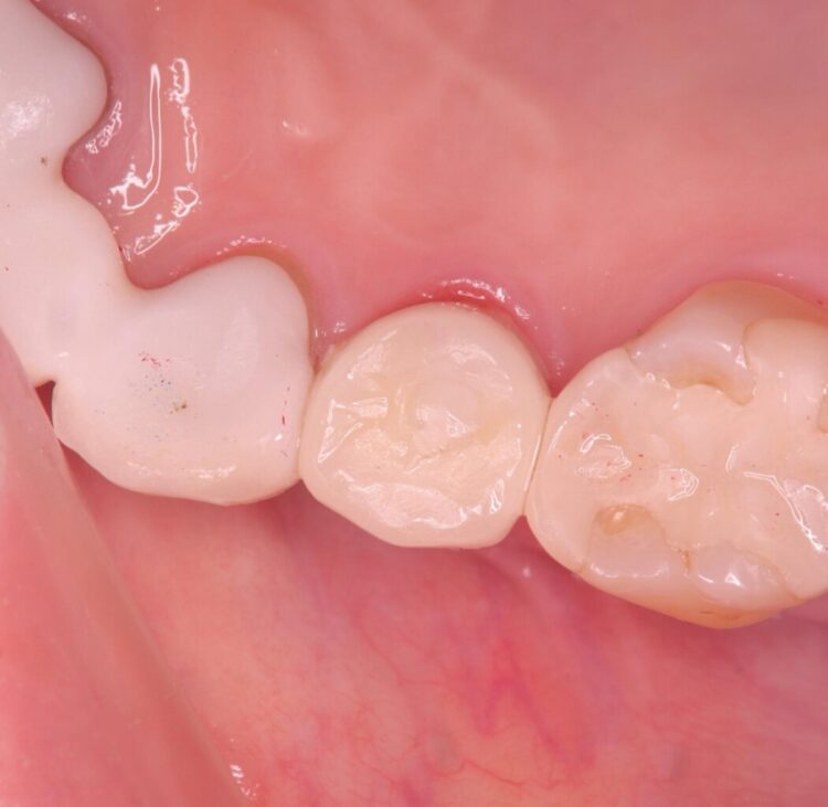 歯根破折による抜歯即時インプラント（1DAYインプラント） 治療後画像
