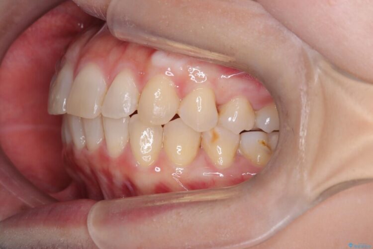 【インビザライン】ガタガタな前歯を整える 治療後画像