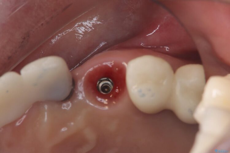【1Dayインプラント】抜歯の即日にインプラントを埋入する 治療後画像