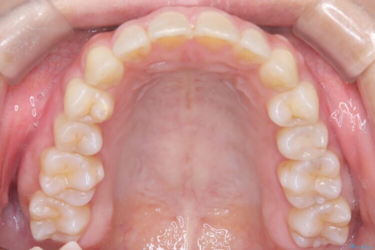 【インビザライン】ガタガタな前歯を整える 治療後画像