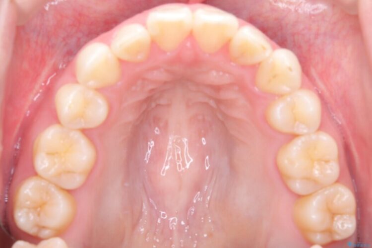 インビザラインでの抜歯矯正治療 治療後画像