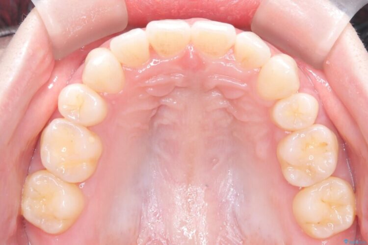 前歯のガタガタをなおしたい　インビザラインでのマウスピース矯正治療 治療後画像