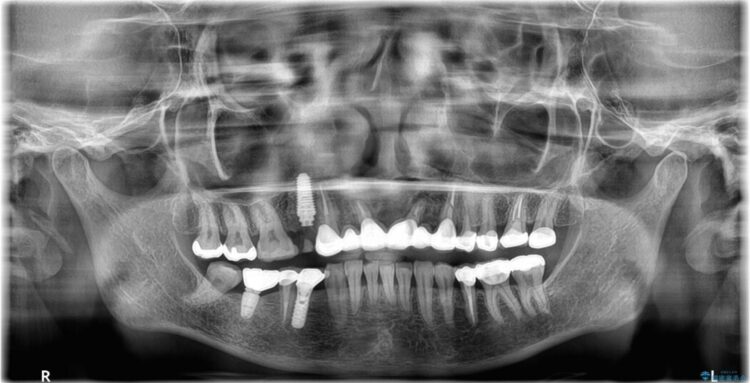 歯根破折による抜歯即時インプラント（1DAYインプラント） 治療後画像