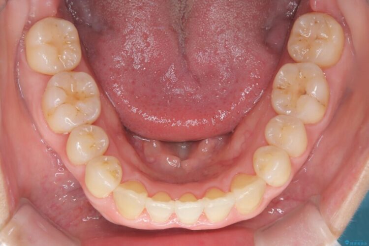 前歯のかみ合わせを改善したい 治療後画像