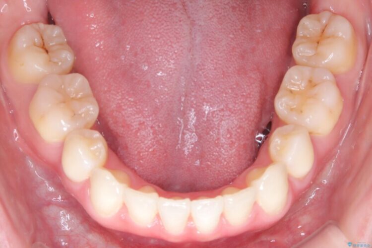 インビザラインでの抜歯矯正治療 治療後画像