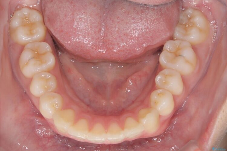 前歯の正中線のズレをなおす 治療後画像