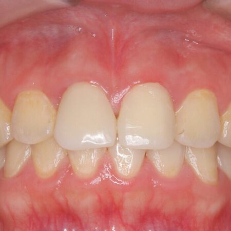 白い被せ物のやり替え前にホワイトニングで全体的に明るく 治療前