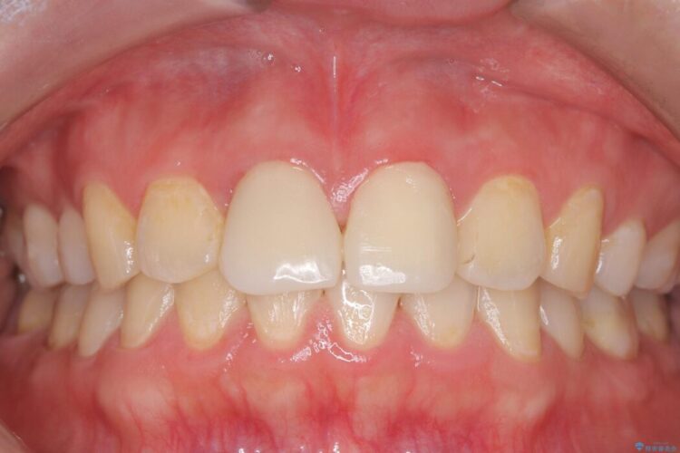 白い被せ物のやり替え前にホワイトニングで全体的に明るく 治療前画像