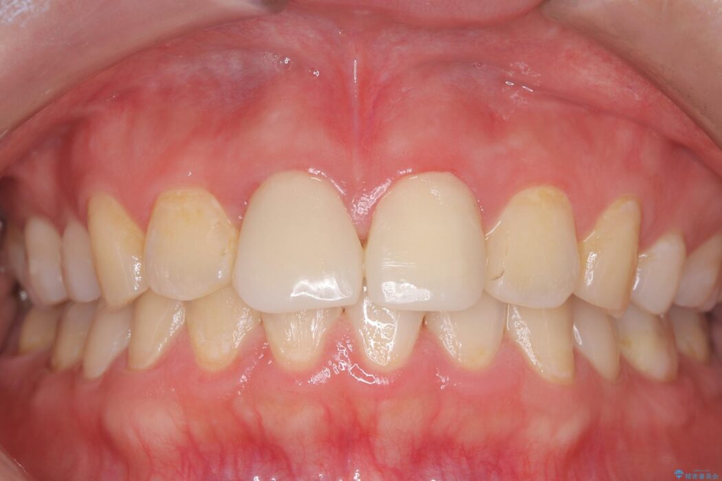 白い被せ物のやり替え前にホワイトニングで全体的に明るく 治療前