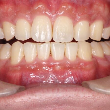 矯正治療後のオフィスホワイトニング 治療前