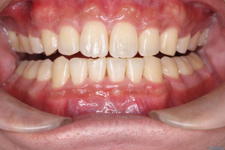 矯正治療後のオフィスホワイトニング 治療前画像