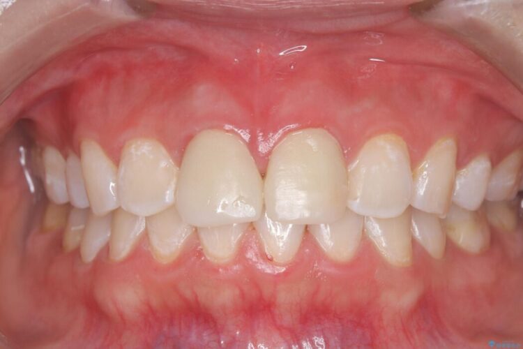 白い被せ物のやり替え前にホワイトニングで全体的に明るく 治療後画像