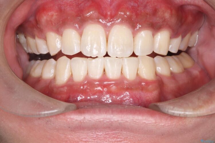 矯正治療後のオフィスホワイトニング 治療後画像