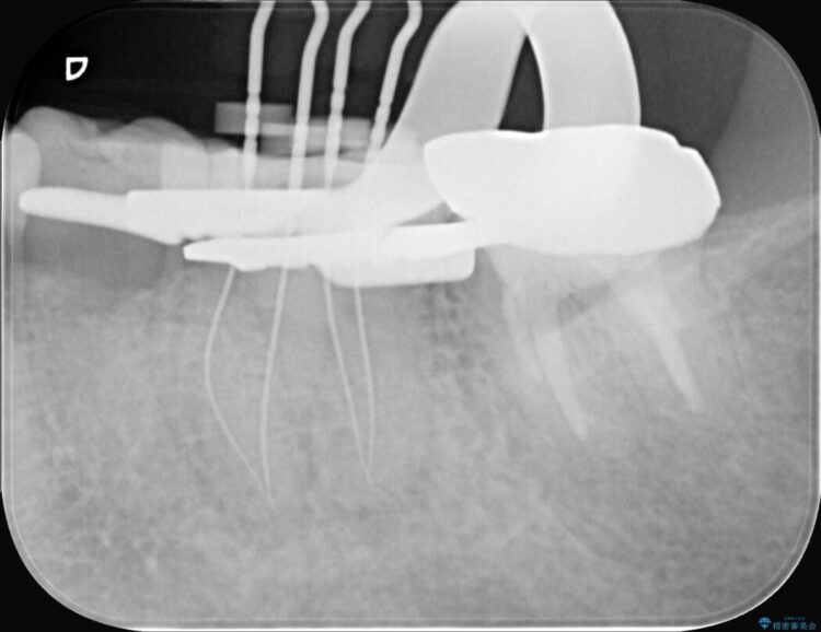 奥歯の痛み、顕微鏡を使用した精密根管治療で解消 治療途中画像