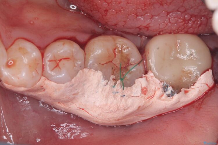 【歯牙移植】抜歯と言われた奥歯に親知らずを移植 治療途中画像