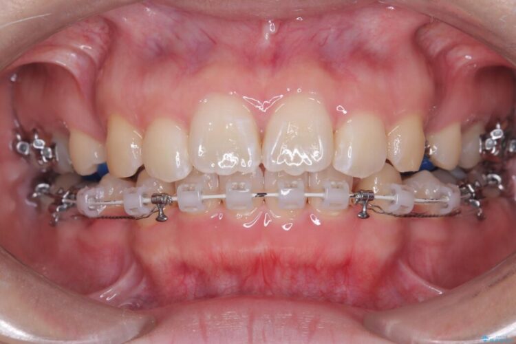 目立たないハーフリンガル矯正で口元の突出感を改善 治療途中画像