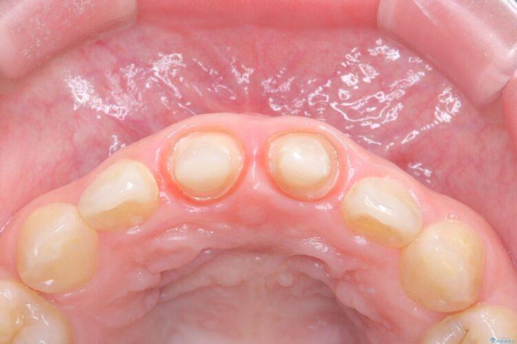 他院で治療した前歯の見た目と根の問題を解決 治療途中画像