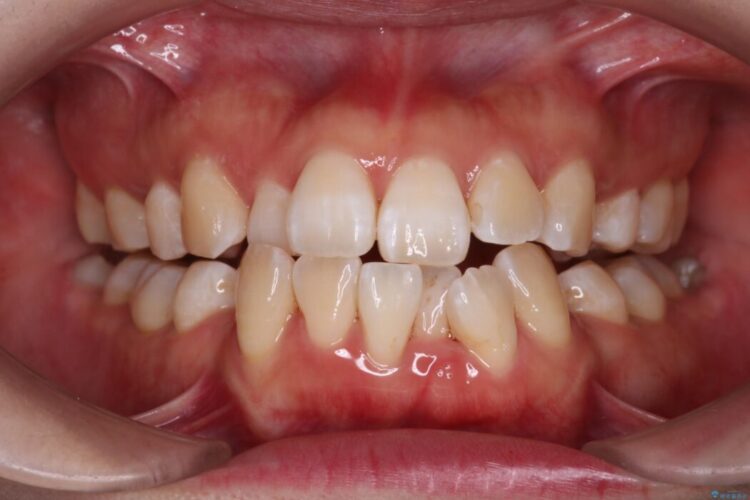重度の叢生をインビザラインで改善 治療途中画像