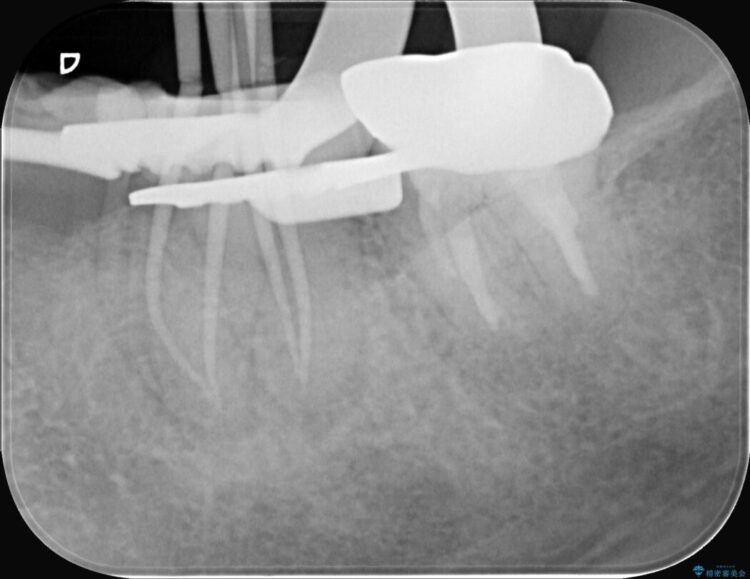奥歯の痛み、顕微鏡を使用した精密根管治療で解消 治療途中画像