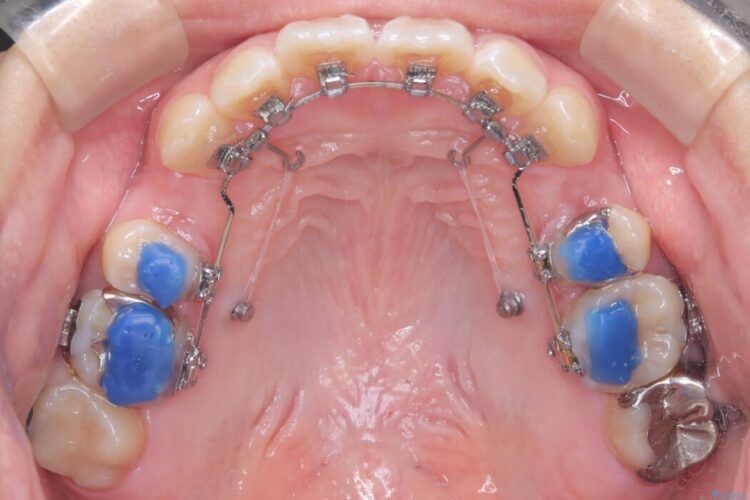 目立たないハーフリンガル矯正で口元の突出感を改善 治療途中画像