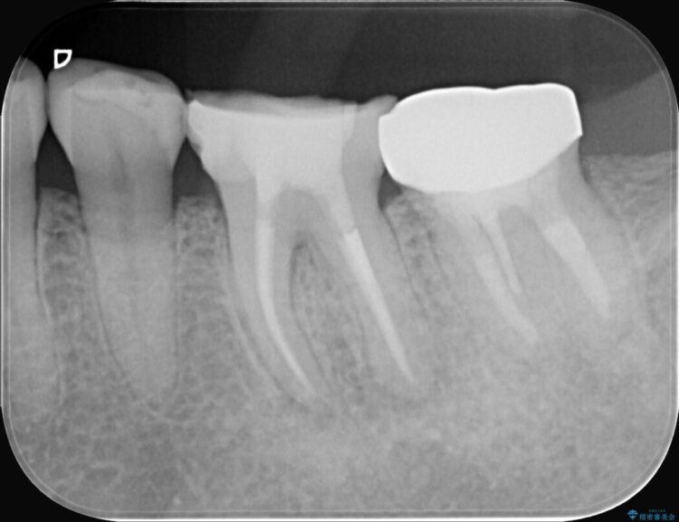 奥歯の痛み、顕微鏡を使用した精密根管治療で解消 治療途中画像