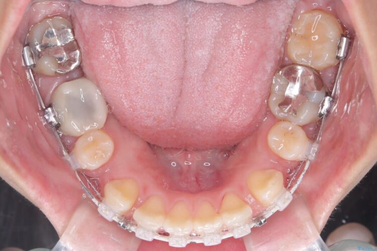 目立たないハーフリンガル矯正で口元の突出感を改善 治療途中画像