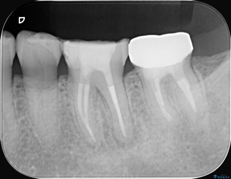 奥歯の痛み、顕微鏡を使用した精密根管治療で解消 治療途中画像